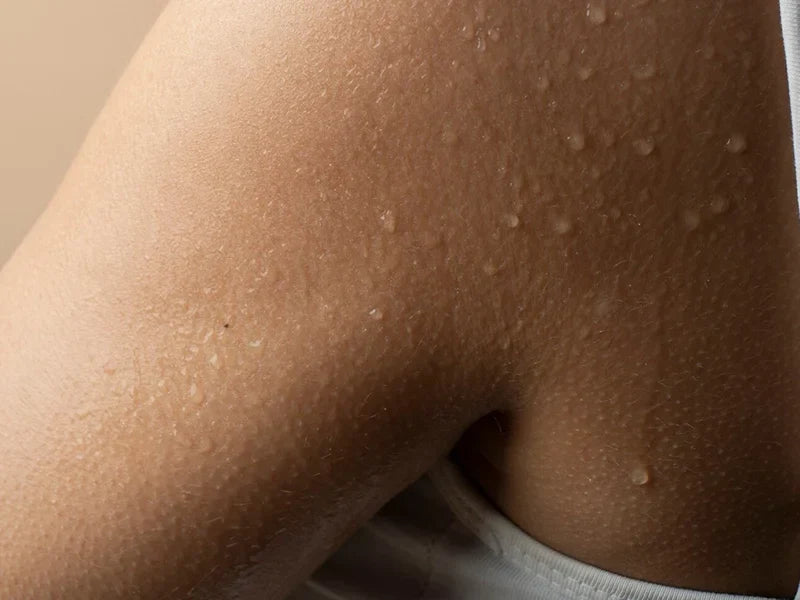 Everything You Need to Know About Keratosis Pilaris