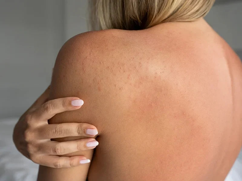 Scrubs for Sensitive Skin: Should You Use Them or Skip Them?